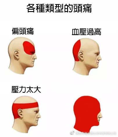 各种类型的头痛