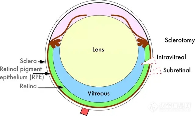 玻璃体注射和视网膜下注射示意图